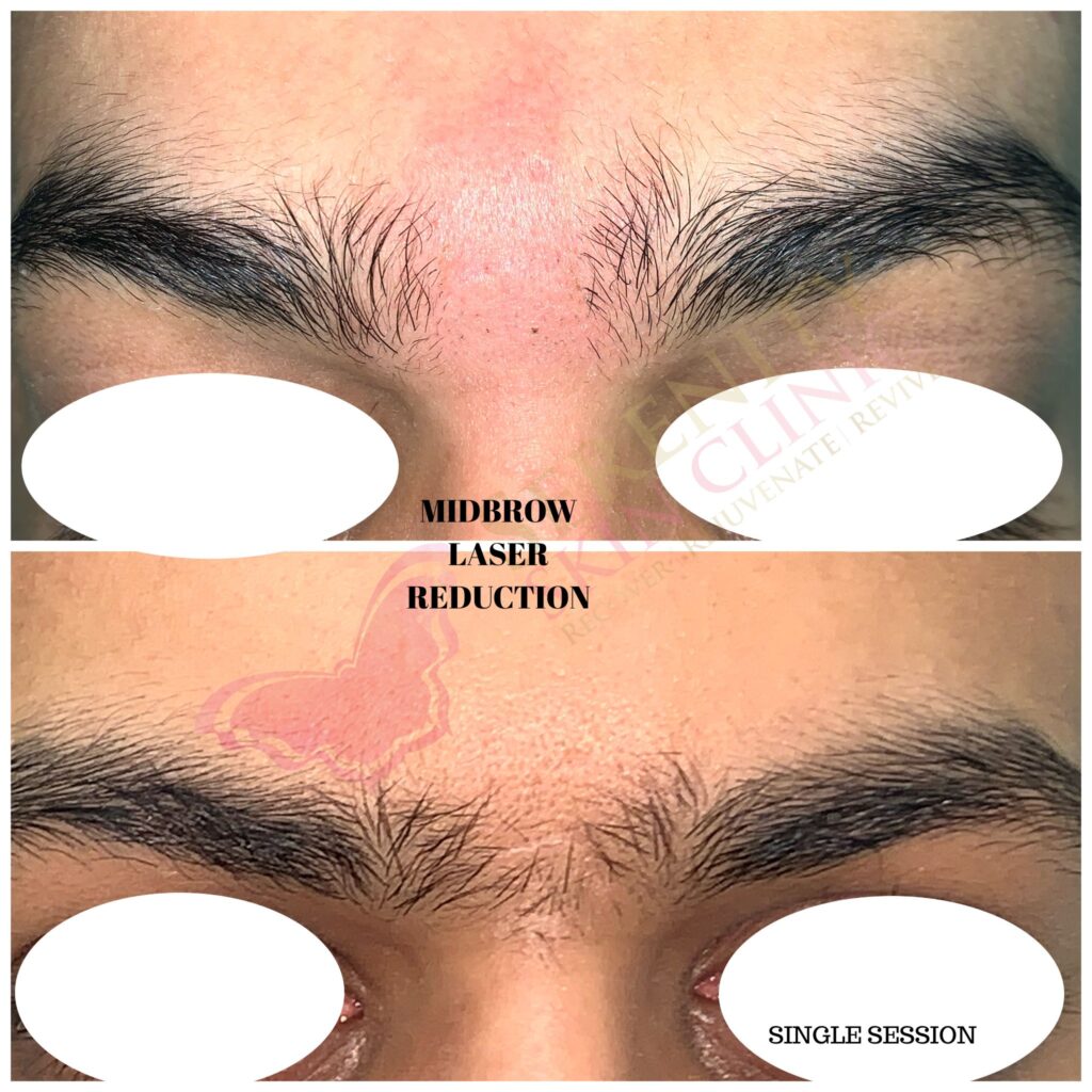 laser hair removal treatment