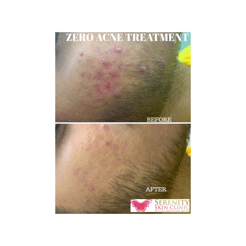 zero acne treatment