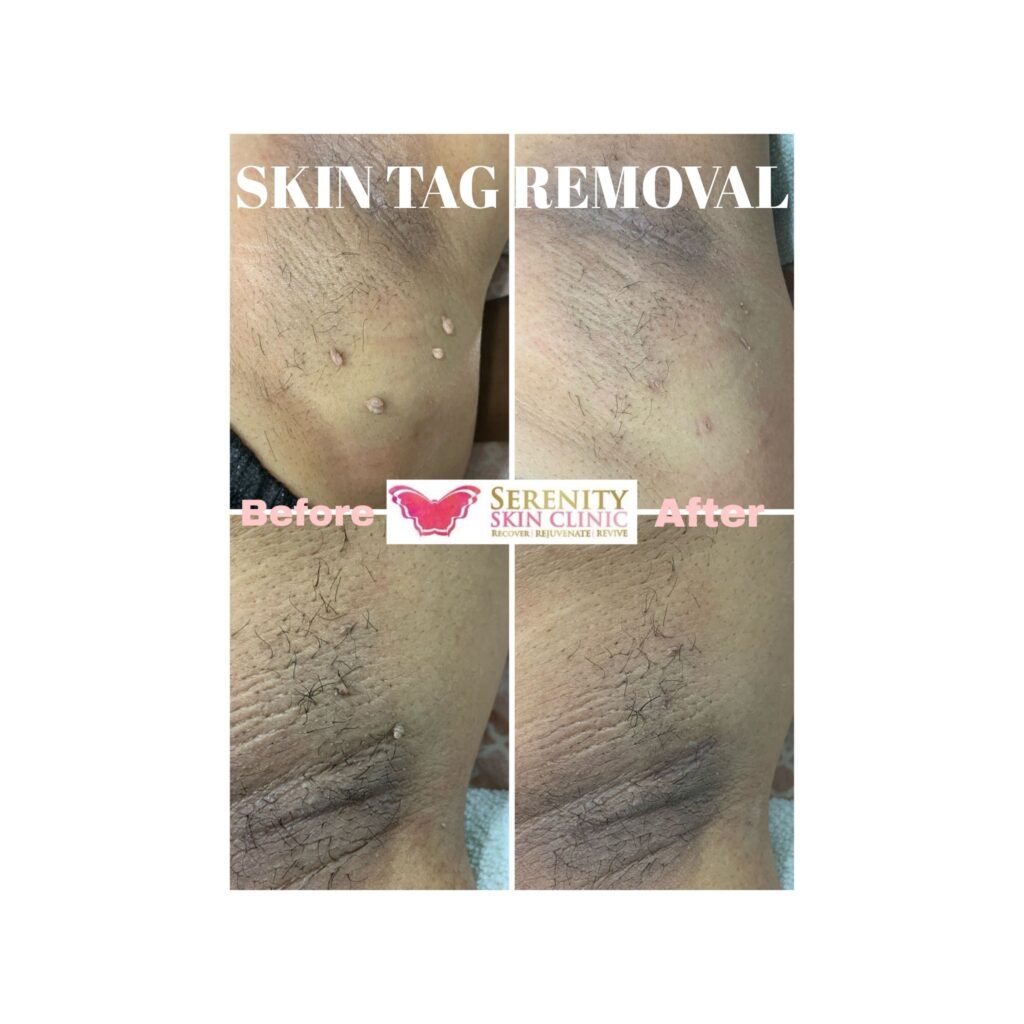 Skin tag removal treatment