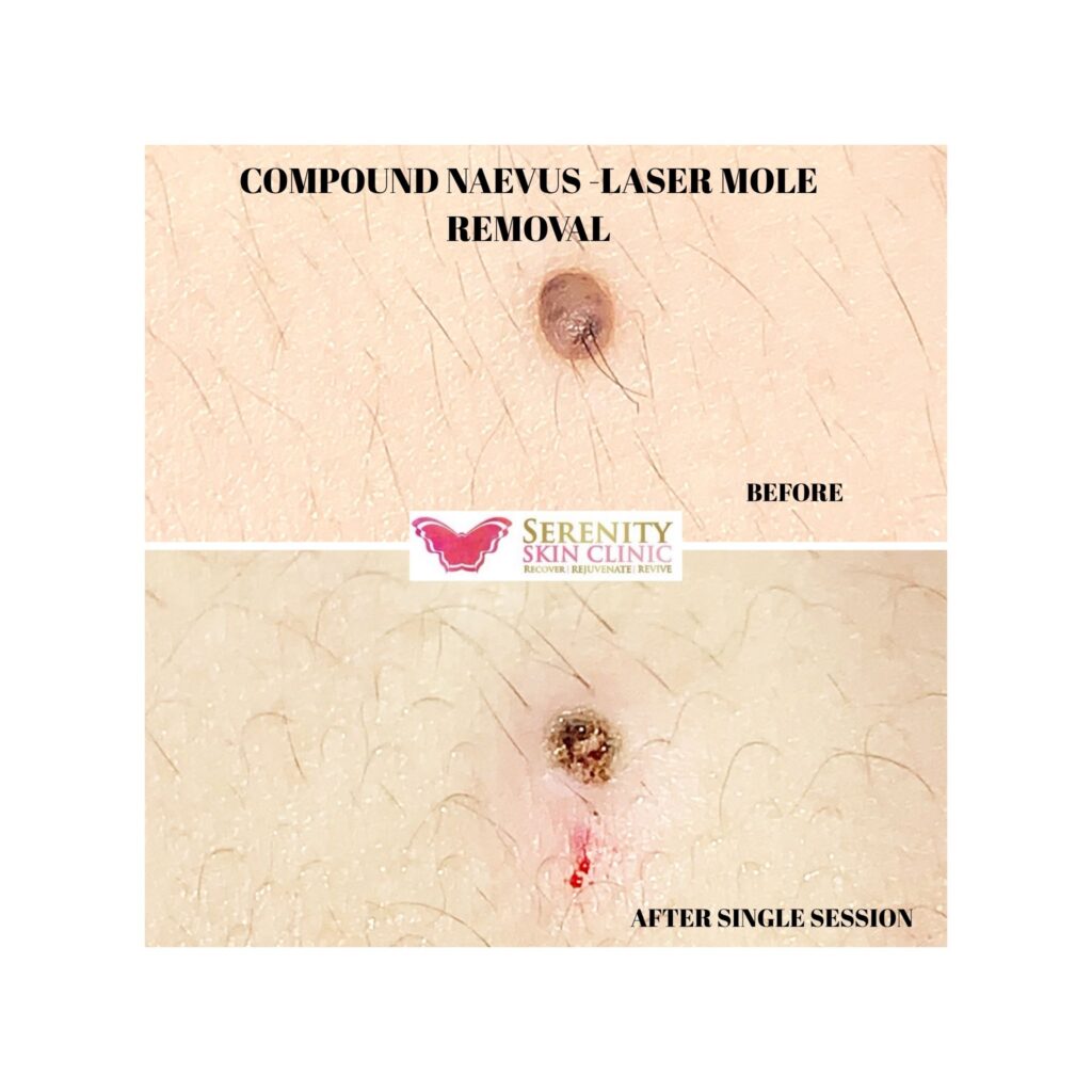 Mole removal treatment