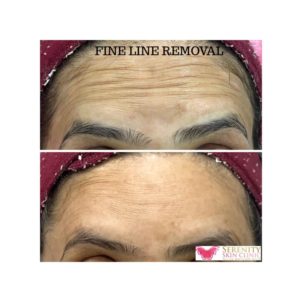 Fine line removal treatment