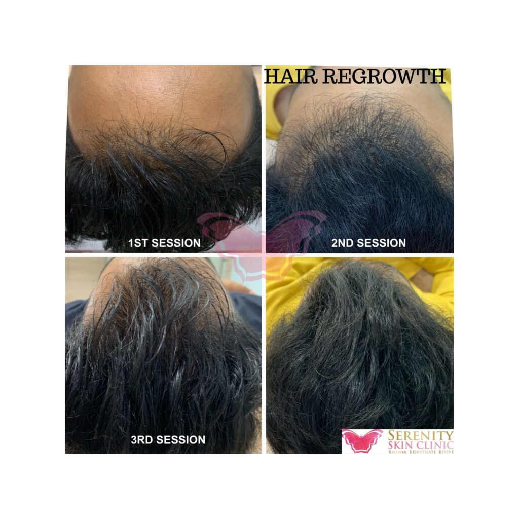 Hair Regrowth Treatment
