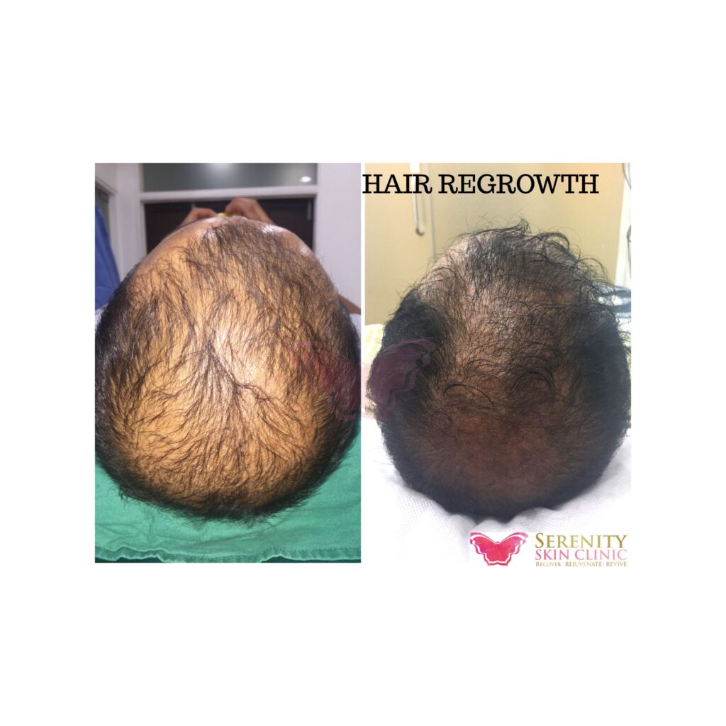 hair regrowth