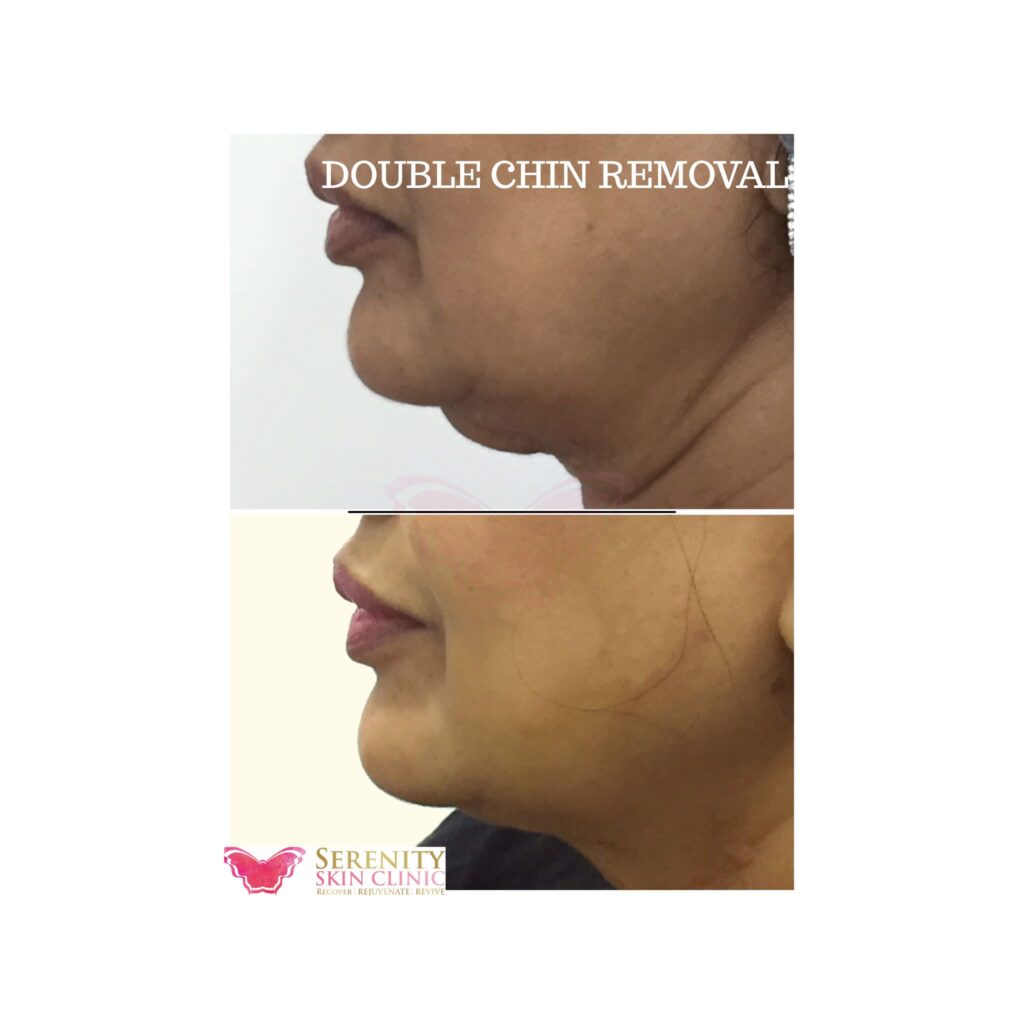 Double chin removal