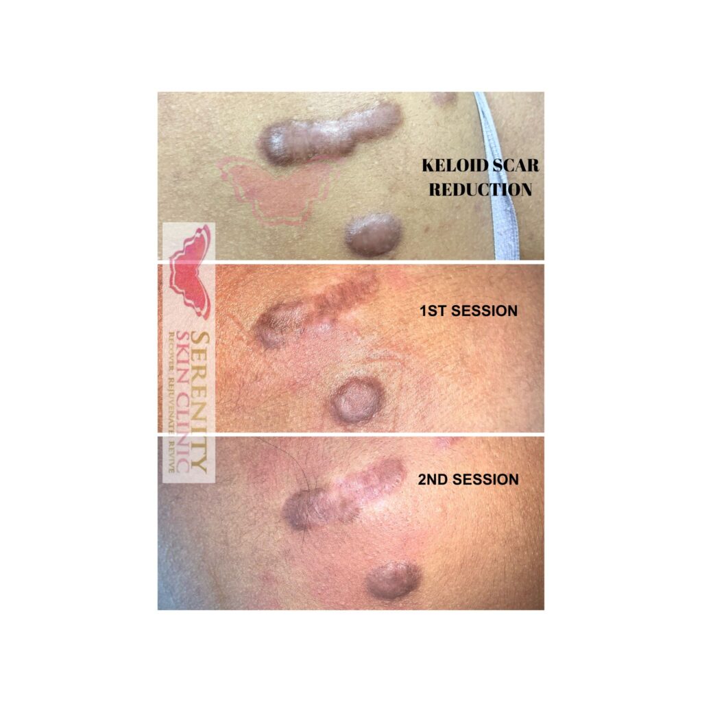 keloid scar treatment
