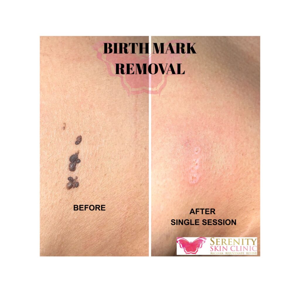 birthmark removal treatment
