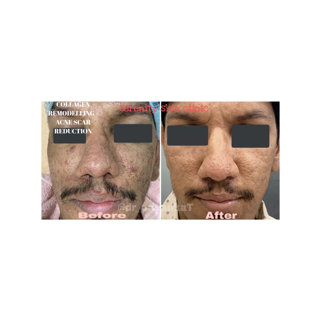 acne scar reduction treatment