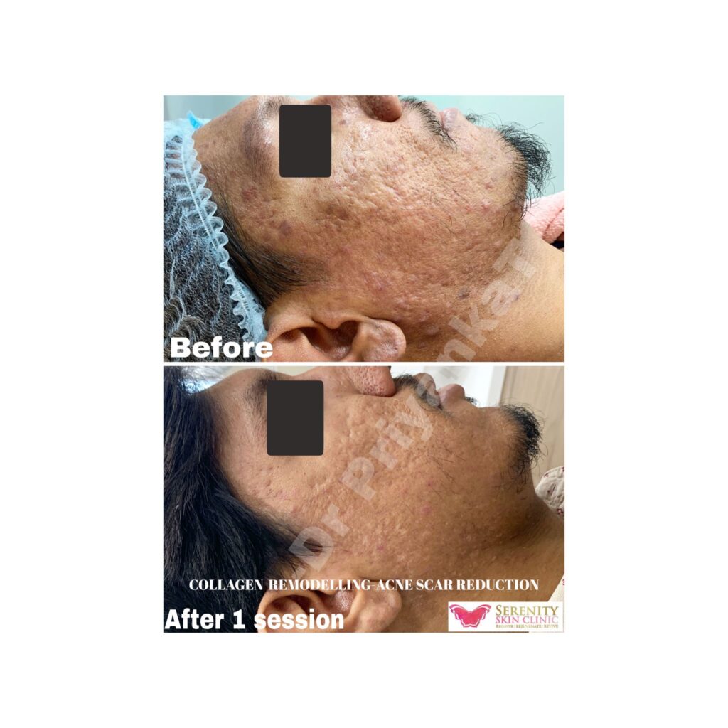 acne scar reduction